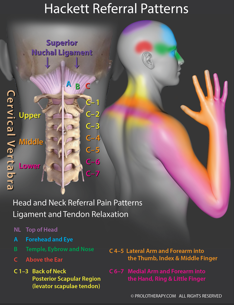 Hackett Pain Referral Patterns of the Neck Ligaments showing injury in the neck can cause pain sensations in the upper limbs. Prolotherapy can help treat the pain.
