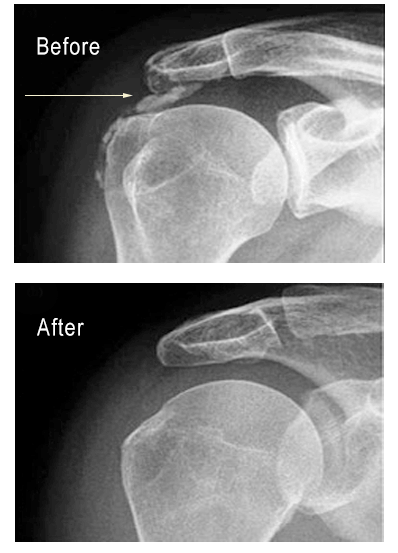 a before and after x-ray image of a calcium deposit subsiding on a shoulder bone