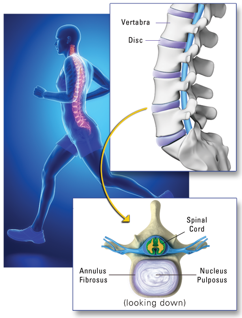 Prolotherapy - Low Back Pain and Sciatica