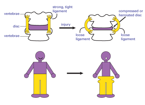 A human figure with it's pants falling down illustrating what happens when loose ligaments form from disc compression