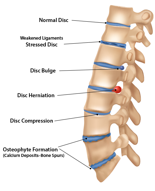 An anatomical drawing showing the stage and types of spinal disc degeneration: Normal disc, degenerating disc, disc protrusion, disc herniation, thinning disc, osteophite formation