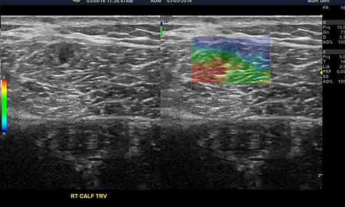 Sonoelastogram showing a small muscle tear