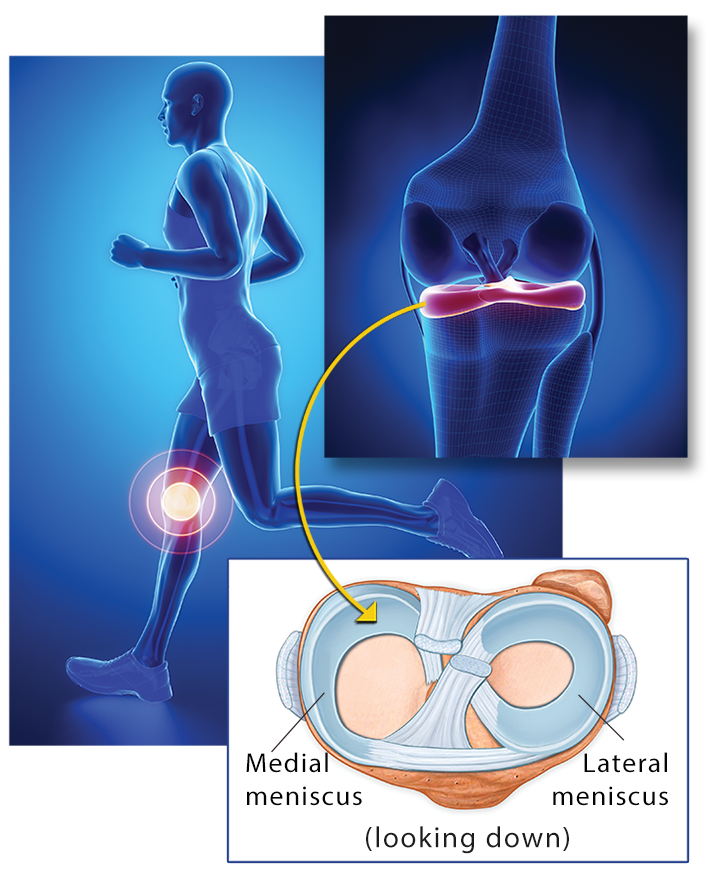 n x-ray image of a runner montaged with images showing the ligament antatomy of the knee.