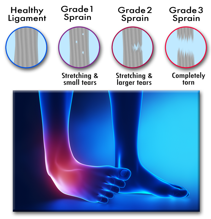 How sprains are graded as to severity